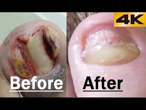 Ingrown Toenail FIXED before and after Removal