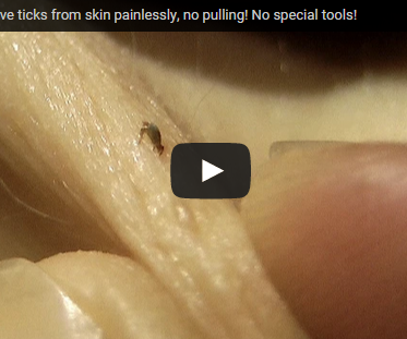 Remove Ticks From Human Skin With a Thread